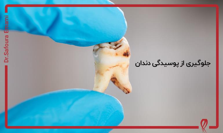 بهترین راه جلوگیری از پوسیدگی دندان چیست؟